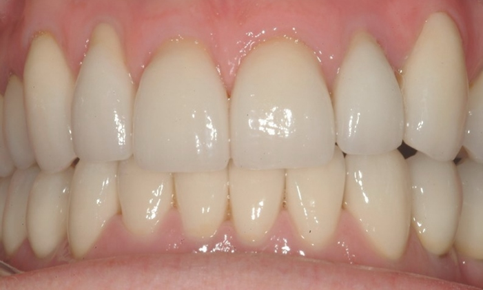 smooth white smile after veneers armagh
