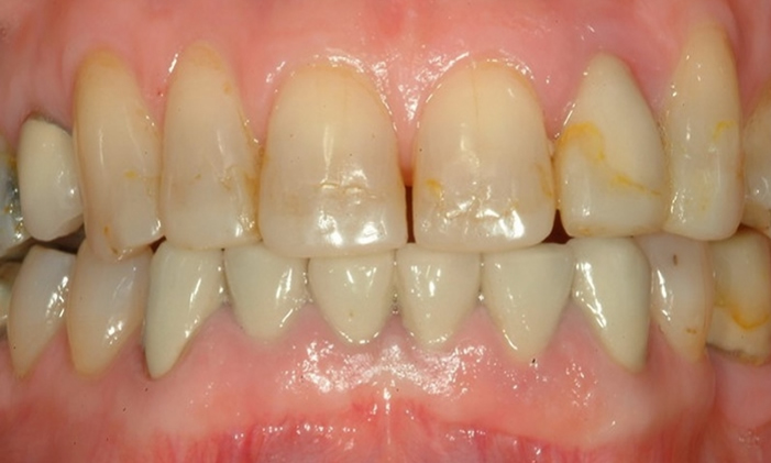 uneven stained smile before dental veneers northern ireland