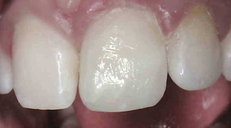 tooth repaired with composite