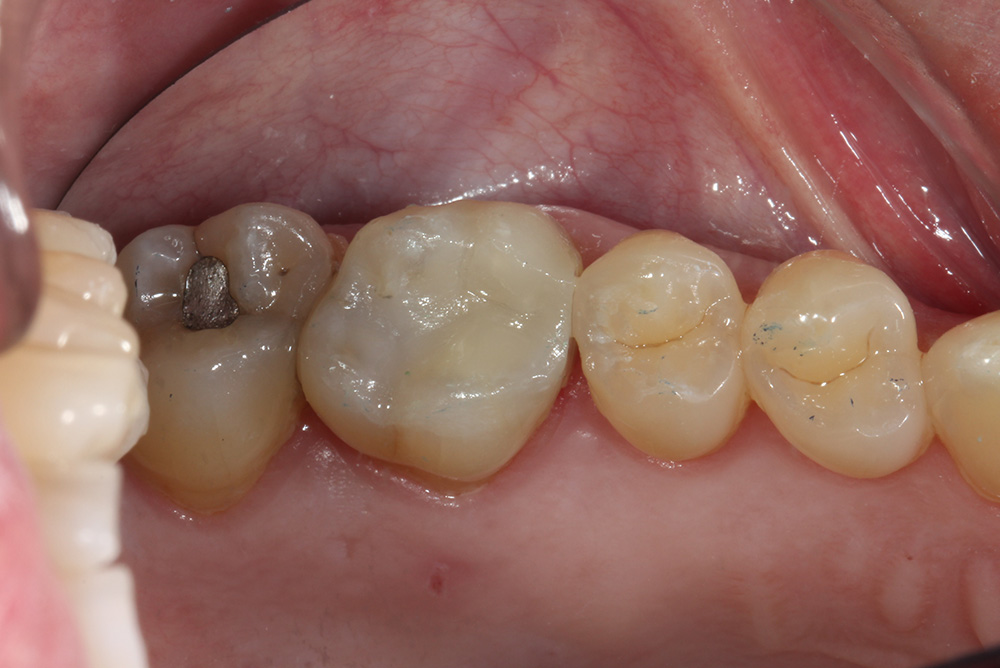 composite filling markethill