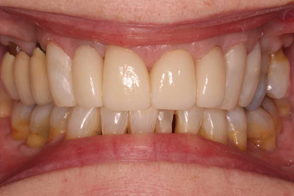 NEw smile after porcelain crown fitted at Dentistry @ Markethill