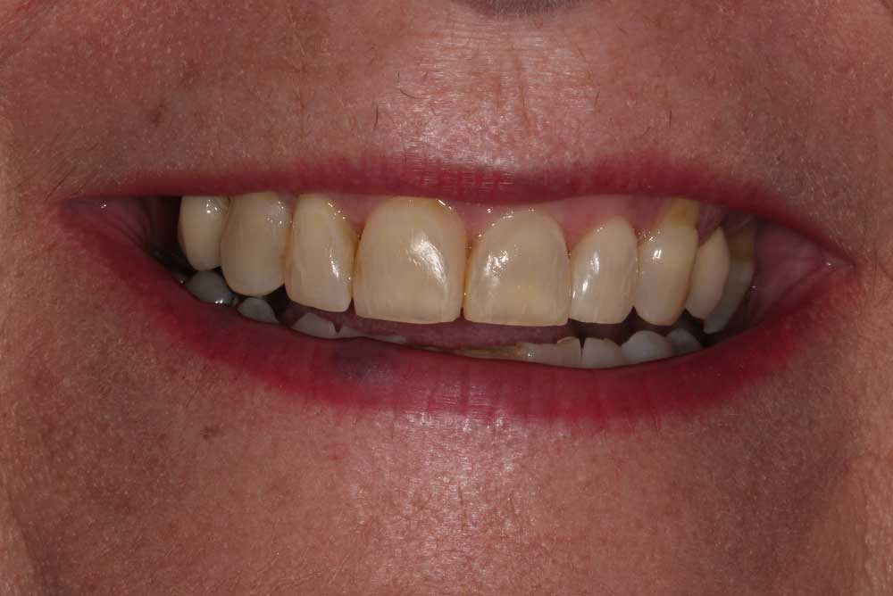 Straight smile with no gap after using adult braces armagh