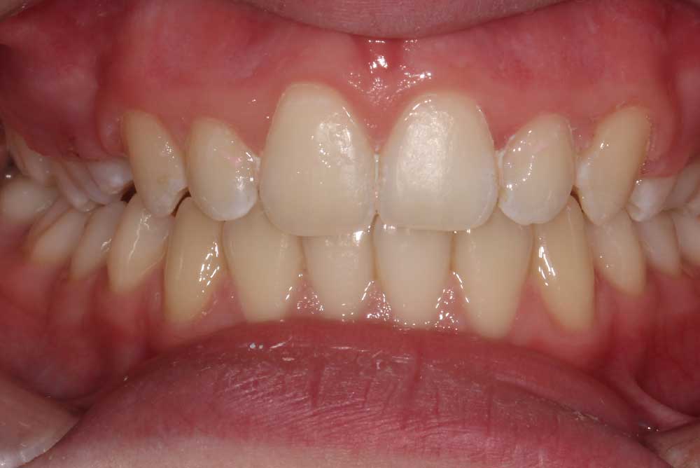 teenage orthodontics  armagh
