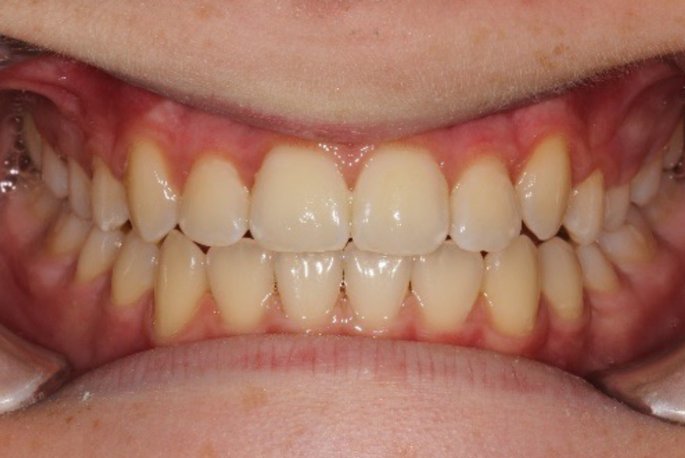 dental crowns armagh