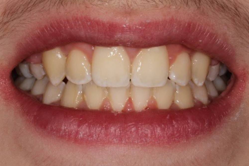 dental crowns armagh