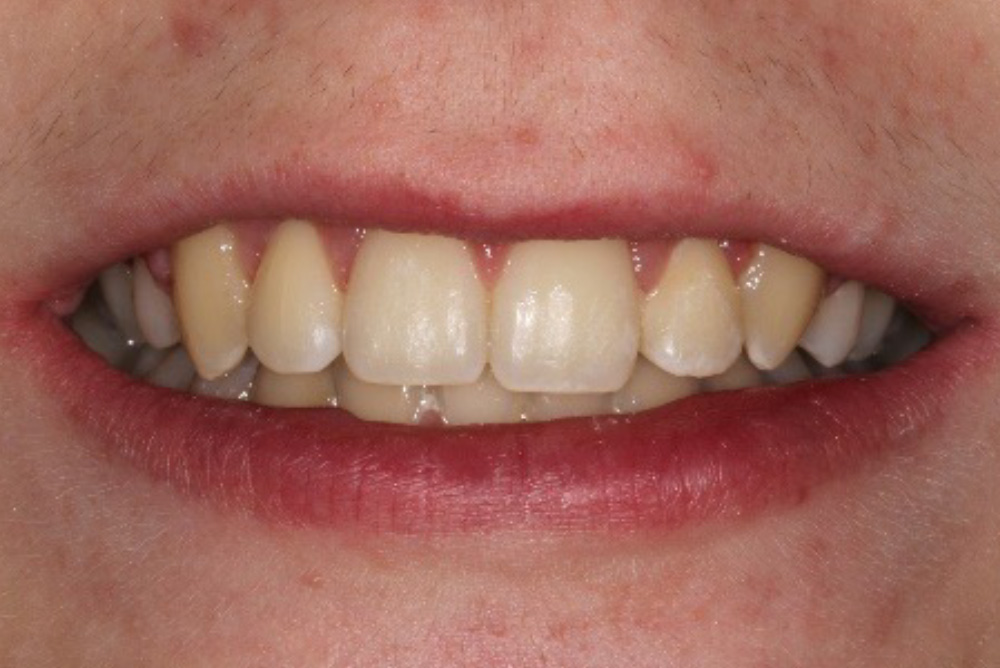 dental crowns armagh