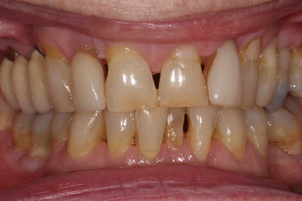 Before replacement of crowns on upper teeth