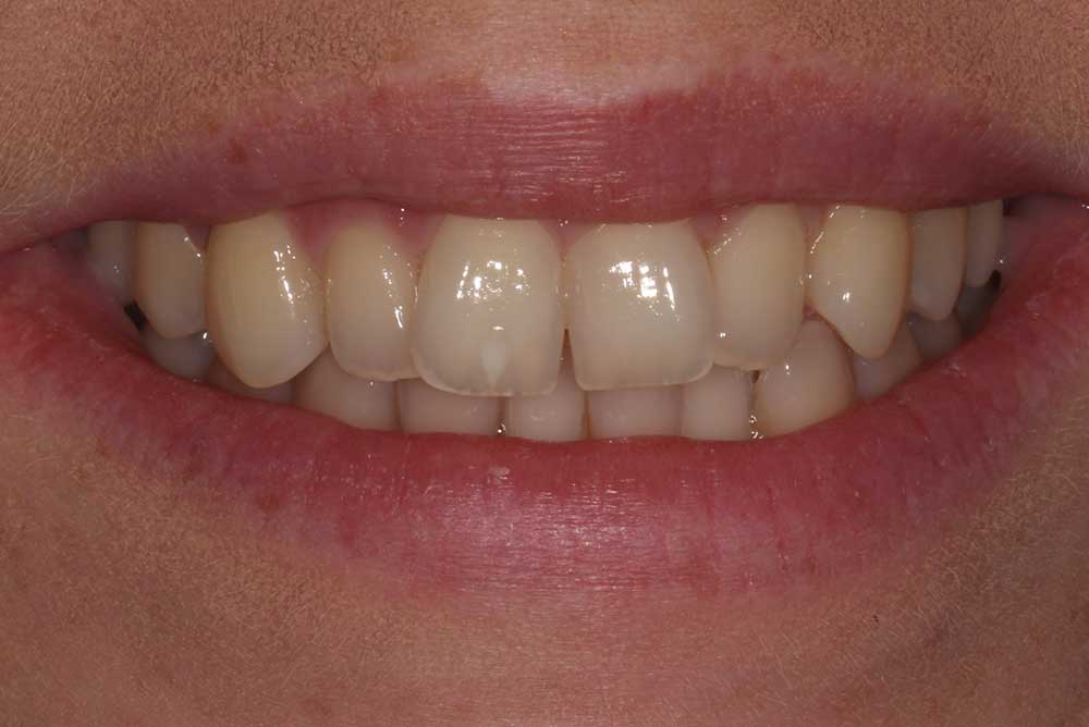 Invisalign Adult Braces in Co Armagh. Dentistry Markethill