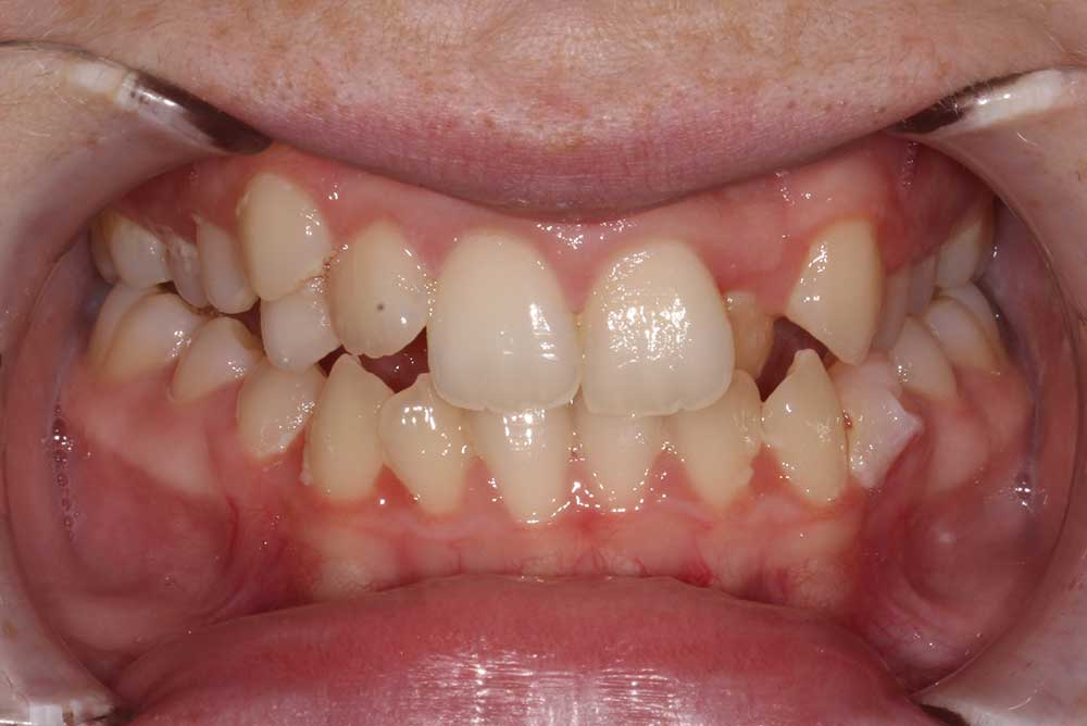 dental implants northern ireland