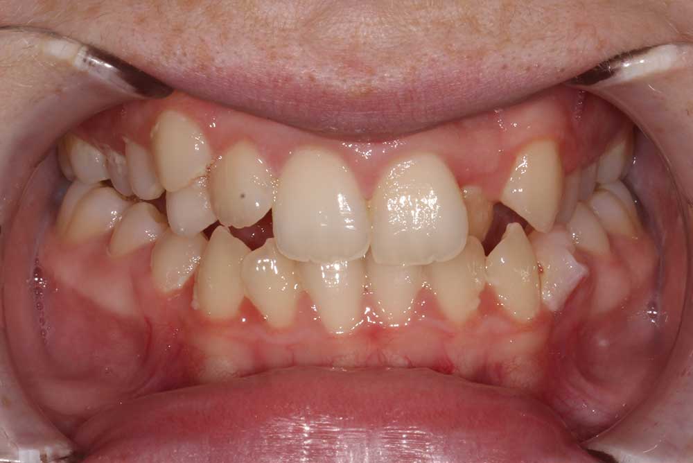 dental implants northern ireland