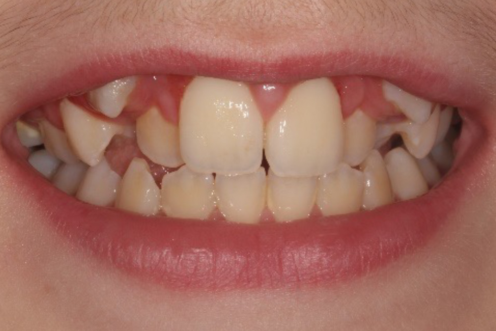 dental implants northern ireland