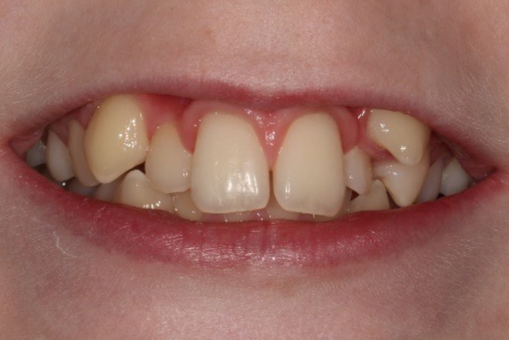 dental implants northern ireland