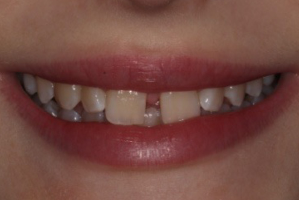 dental implants northern ireland