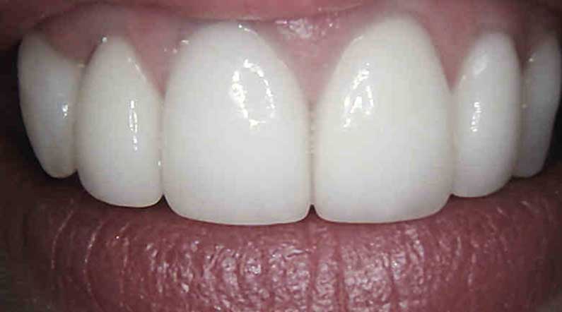 dental crowns after in armagh