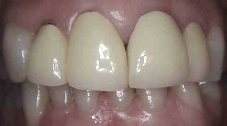 dental Crowns before replacement northern ireland