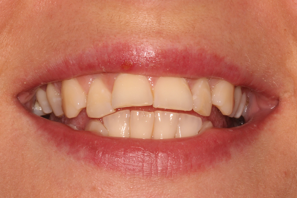 Adult Braces in County Armagh Dentistry Markethill