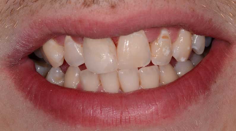 Restored smile with invisible repair
