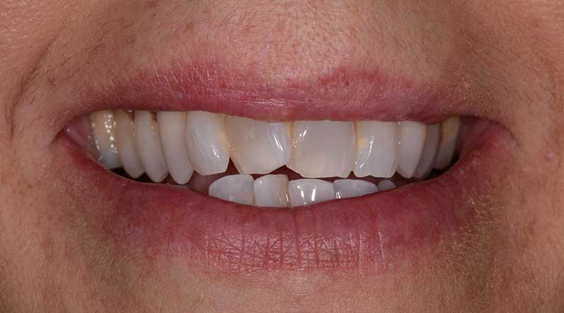 uneven teeth northern ireland